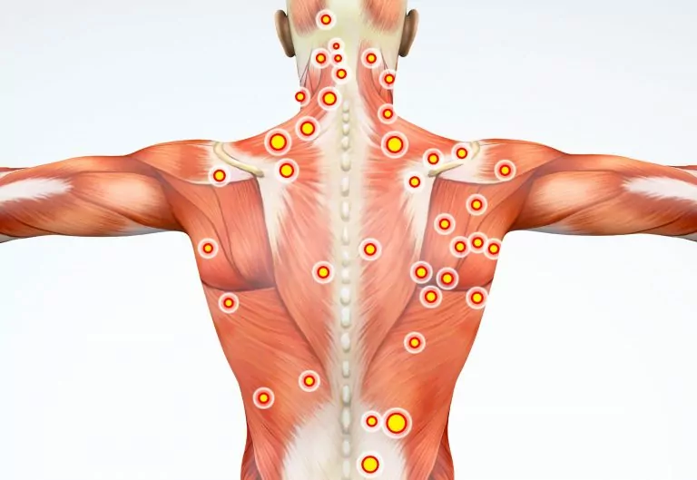 What are Trigger Points?